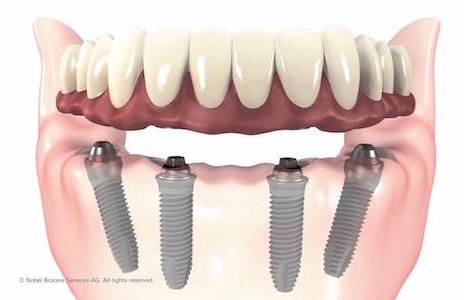 3D illustration of how All-on-4 dental implants fit into the jaw. 