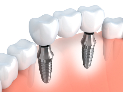 3D rendering of how dental implants fit into the jaw between natural teeth. 